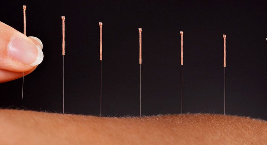 Acupuntura se destaca como alternativa eficaz no tratamento da dor