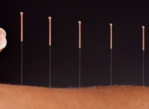 Acupuntura se destaca como alternativa eficaz no tratamento da dor