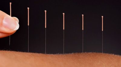 Acupuntura se destaca como alternativa eficaz no tratamento da dor